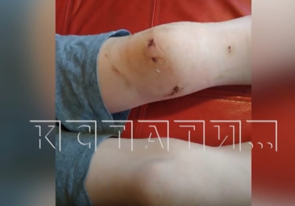 «12 швов на руке, 3 — на ноге»: тибетский мастиф покусал 9‑летнего мальчика в Нижегородской области