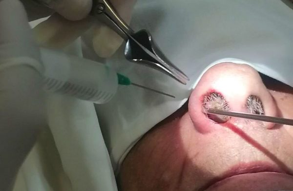 Врачи удалили опухоль размером с грецкий орех из носа нижегородца