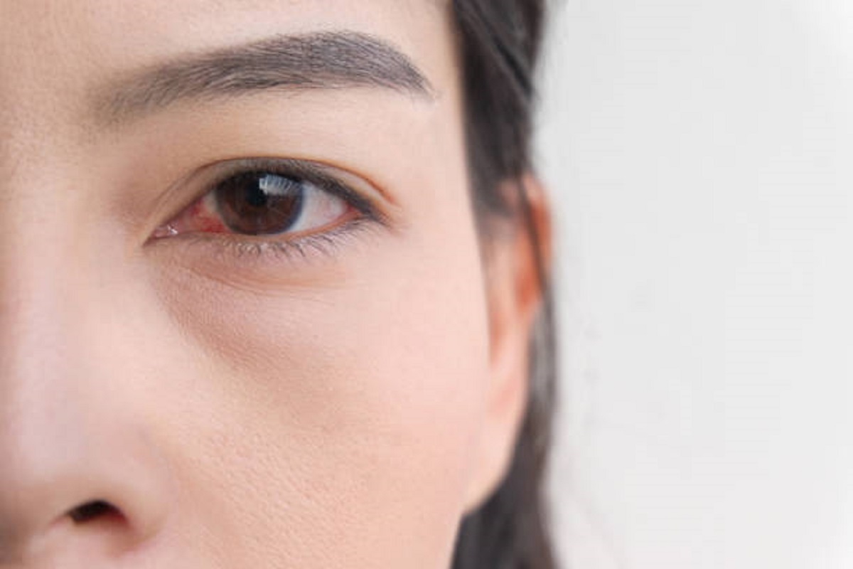 Врач-офтальмолог рассказала о причинах покраснения глаз