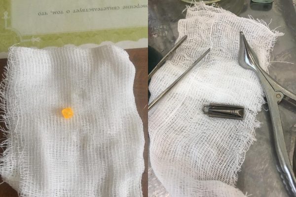 Нижегородские ЛОРы достали молнию и бусинку из носов&nbsp;детей