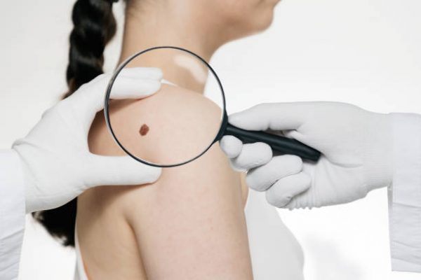 Более 500 тысяч заявок на диагностику новообразований кожи было обработано с помощью приложения «ПроРодинки»