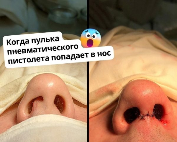Нижегородский хирург восстановил пациенту пострадавший от пульки пневматического пистолета нос