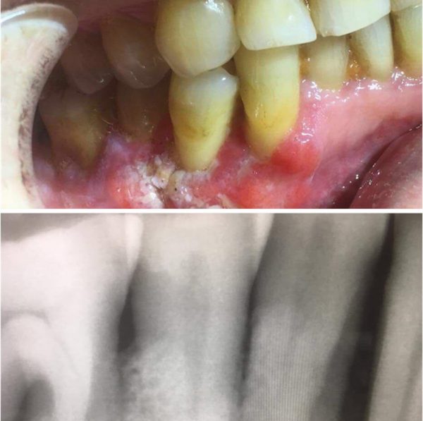 Врачи нашли плоскоклеточный рак у нижегородца после месяца самолечения полосканием