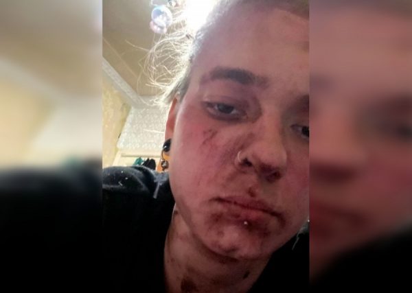 Победительница шоу «Новые пацанки» Кира Медведева опубликовала фотографии с разбитым лицом