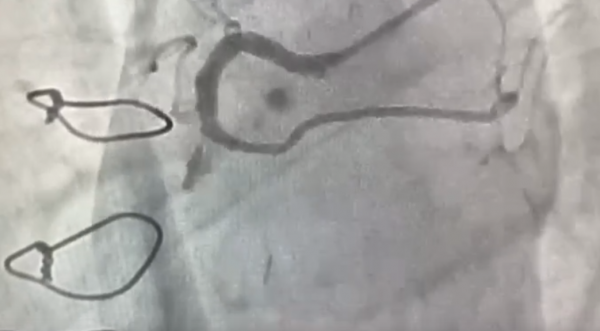 Первую операцию по коронарошунтографии провели в региональном сосудистом центре в Арзамасе