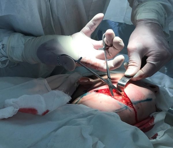 13 нижегородцев госпитализировали с челюстно-лицевыми флегмонами и абсцессами из-за холодов