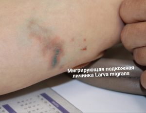 Опасную подкожную личинку привезла нижегородка из Доминиканы