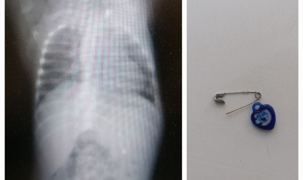 Младенец проглотил расстегнутую булавку с подвеской-оберегом в Нижнем Новгороде