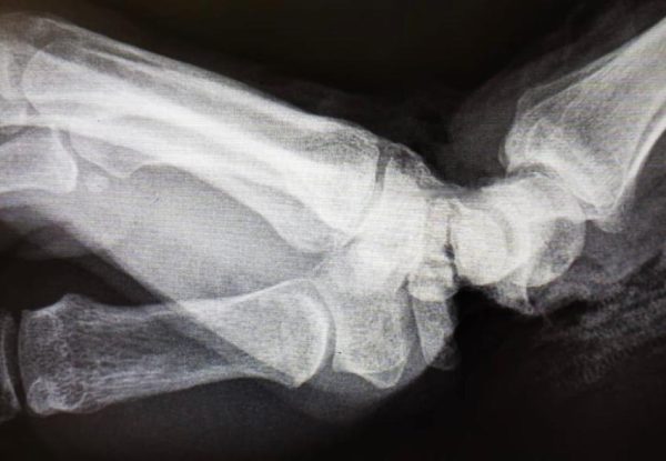 Нижегородские врачи спасли кисть женщине из Владимира после несчастного случая на производстве