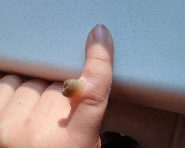 Редкую бородавку устранили нижегородские врачи у ребенка из Европы