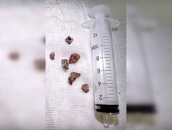 Ринолит из остатков ваты рос 20 лет в носу у нижегородки