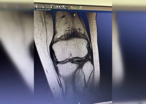 Редчайшую операцию на коленном суставе провели нижегородские врачи пациентке из Чувашии