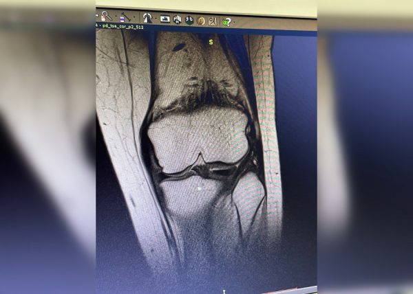 Редчайшую операцию на коленном суставе провели нижегородские врачи пациентке из Чувашии