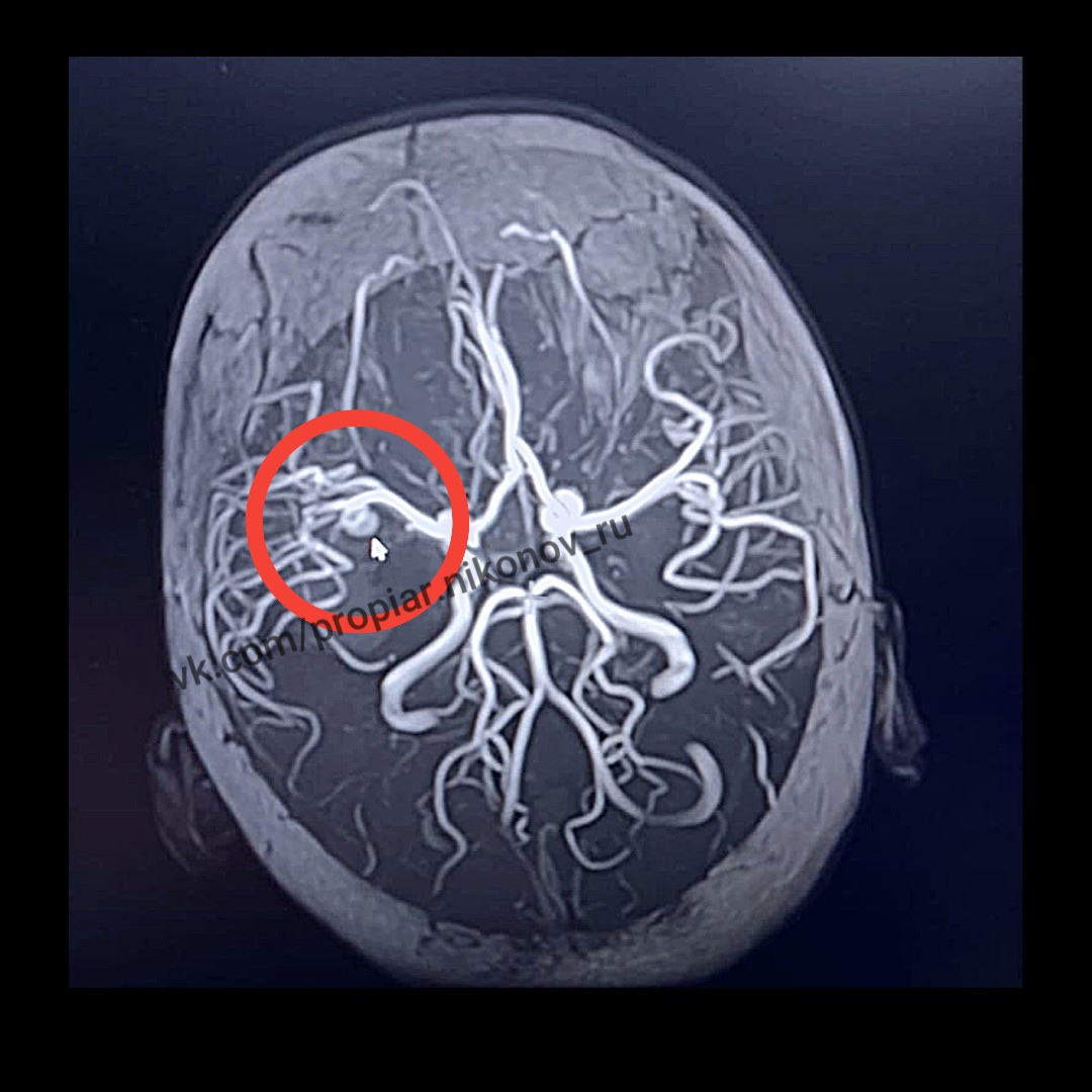 Аневризмы появляются из-за врожденного аномального развития сосудов