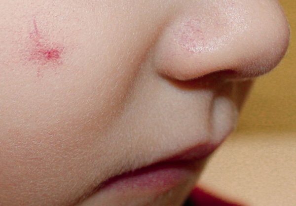 Сосудистого «паучка» удалили с лица юного нижегородца