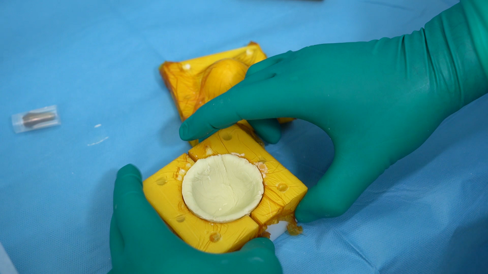 Костнозамещающий материал предназначен для лечения переломов и опухолей костей