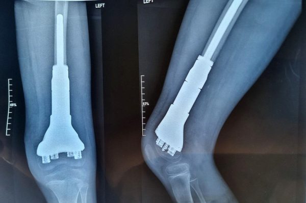 Нижегородские хирурги спасли 9‑летнего ребенка с опухолью бедренной кости