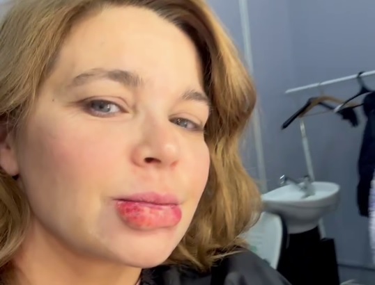 «Вот это губы»: нижегородская актриса Пегова напугала поклонников разбитой губой