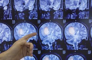 Нижегородские ученые начали испытывать вакцину от опухоли мозга