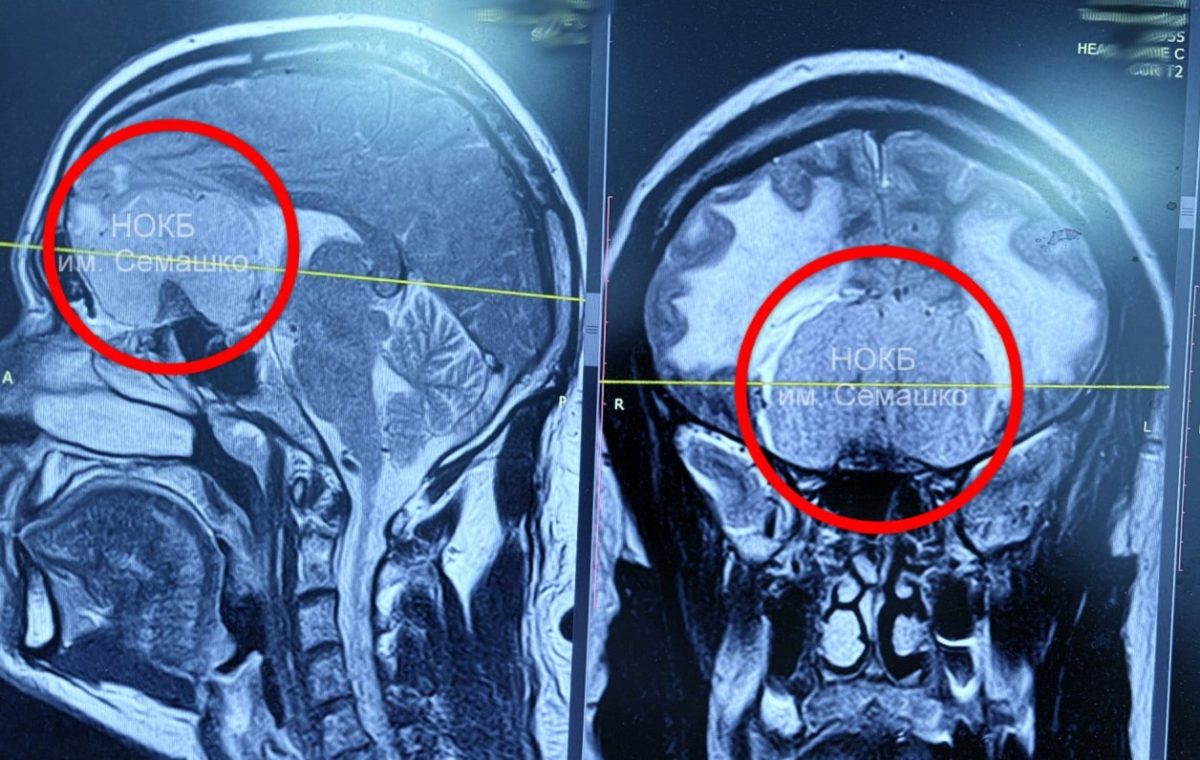 Пациента с гигантской опухолью мозга спасли в Нижнем Новгороде