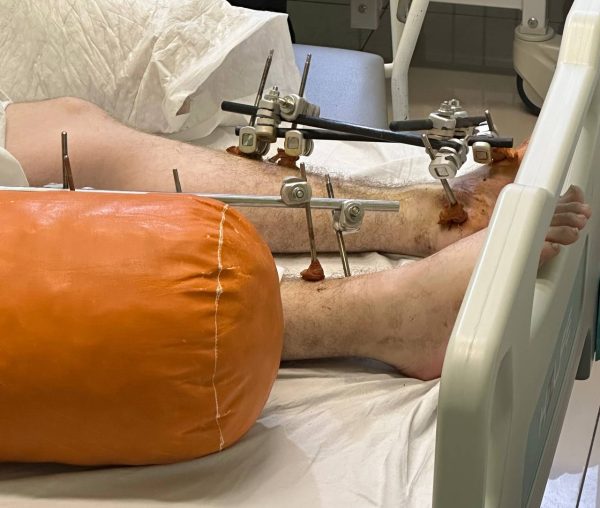 Нижегородские врачи спасли от инвалидизации парня, упавшего с 5&nbsp;этажа