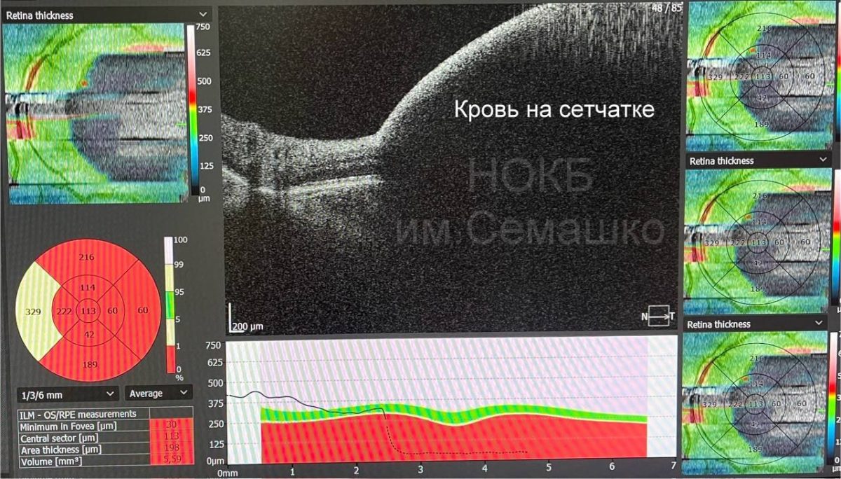 Врачи спасли нижегородца, который внезапно ослеп на один глаз после тренировки