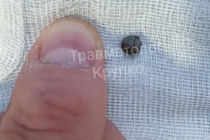 Нижегородский травматолог вытащил осколок боеприпаса из колена бойца&nbsp;СВО