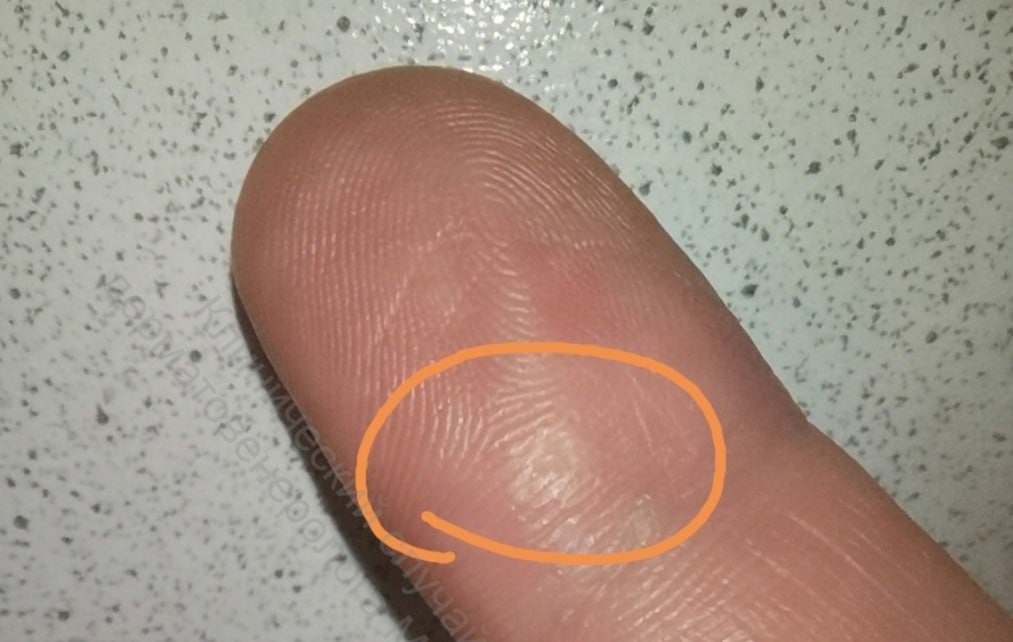 Нижегородский дерматолог Макарычев подцепил вирусную бородавку на тренировке