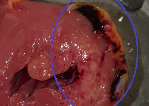 Нижегородские врачи показали, как выглядит сердце при инфаркте миокарда
