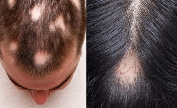 Нижегородка чуть не лишилась волос из-за самолечения тоником с маркетплейса