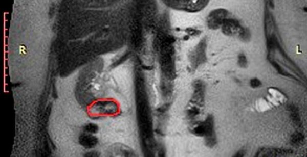 Медики из Нижнего Новгорода спасли единственную почку пациентки с рецидивом рака