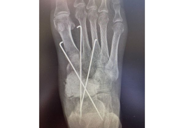 Нижегородские врачи провели операцию замещения поражённой опухолью кости стопы