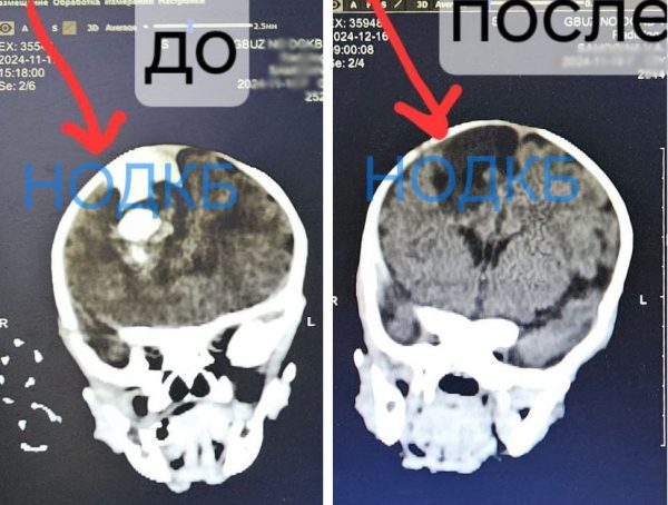 Нижегородские нейрохирурги спасли младенца с кровоизлиянием в мозг