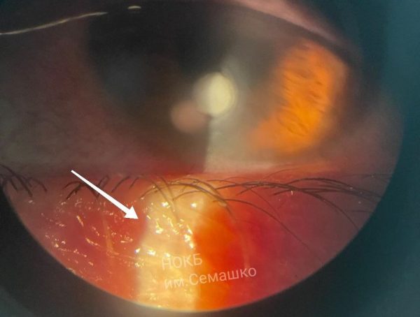 Офтальмологи посоветовали нижегородцам чаще менять контактные линзы