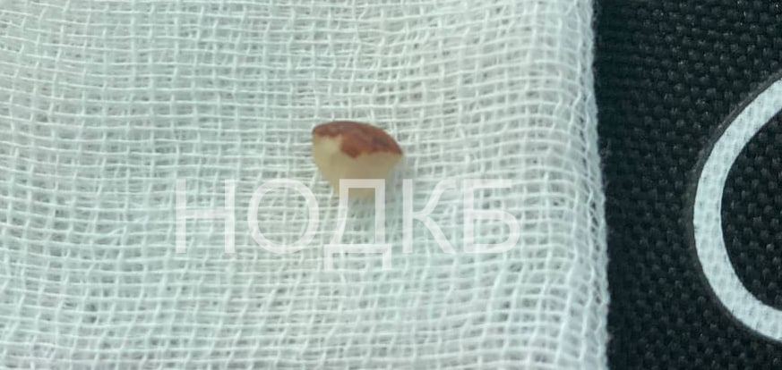 Нижегородские врачи спасли годовалого малыша, подавившегося орехом