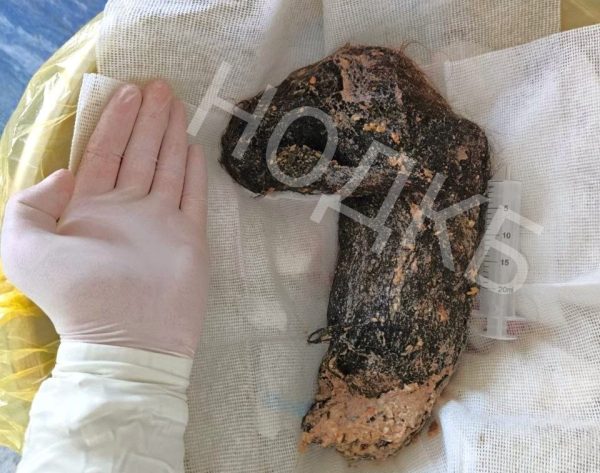 Врачи достали из желудка нижегородки огромный комок волос весом 3&nbsp;кг