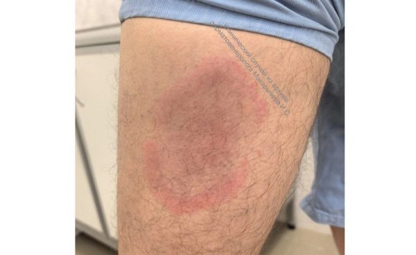 Нижегородец заразился бореллиозом после катания на сапах на Гребном канале