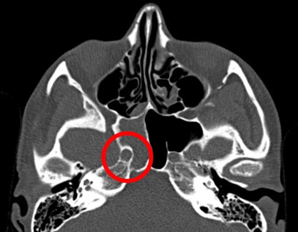 Нижегородке, страдающей от головных болей, удалили грибок в&nbsp;носу