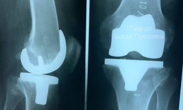 Первое эндопротезирование коленного сустава выполнили в Нижнем Новгороде