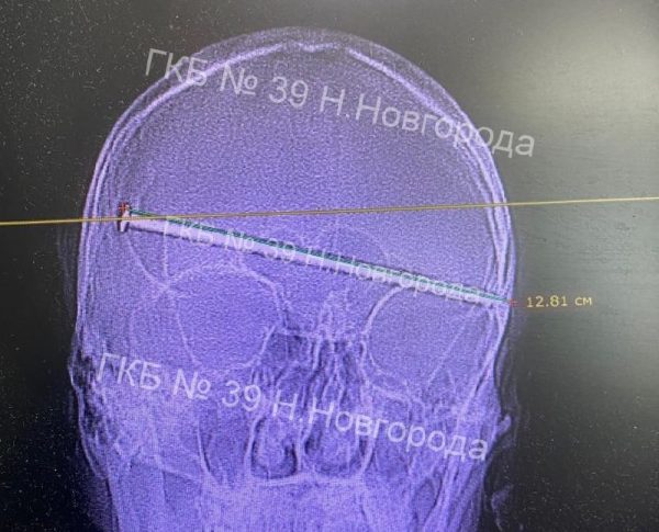 12-сантиметровый гвоздь вытащили из головы мужчины в нижегородской больнице