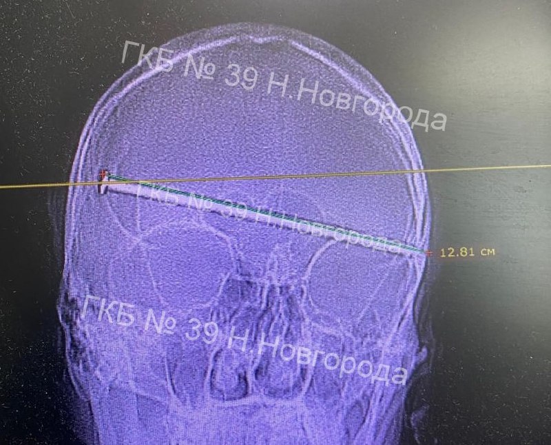 12-сантиметровый гвоздь вытащили из головы мужчины в нижегородской больнице