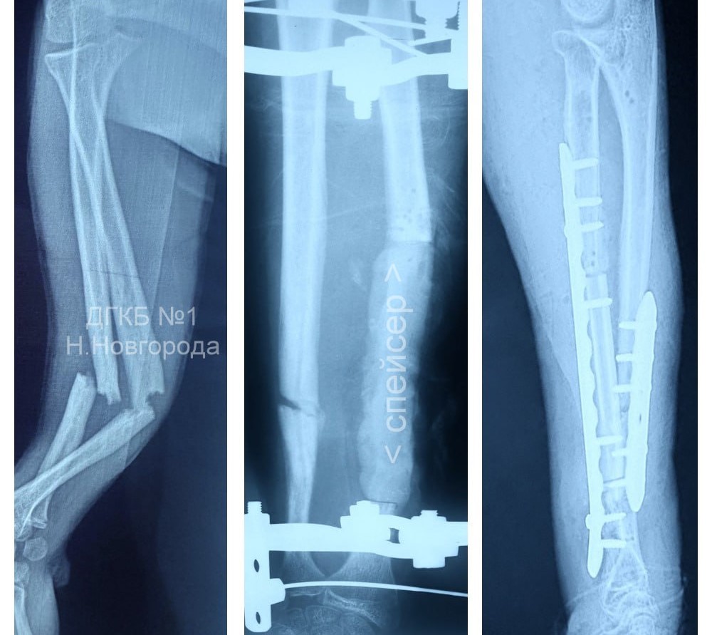 Нижегородские врачи спасли руку подростка после тяжёлой травмы и осложнений