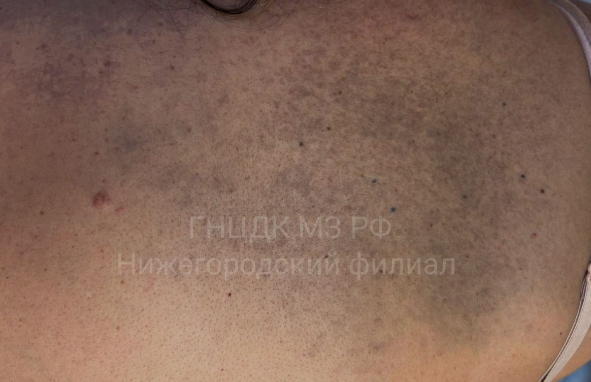 У жительницы Нижегородской области диагностировали редкий невус Ито