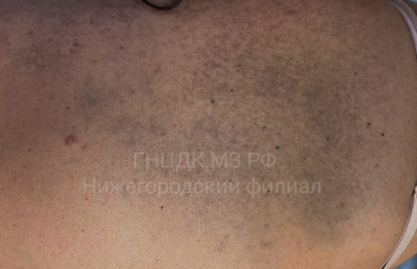 У жительницы Нижегородской области диагностировали редкий невус Ито