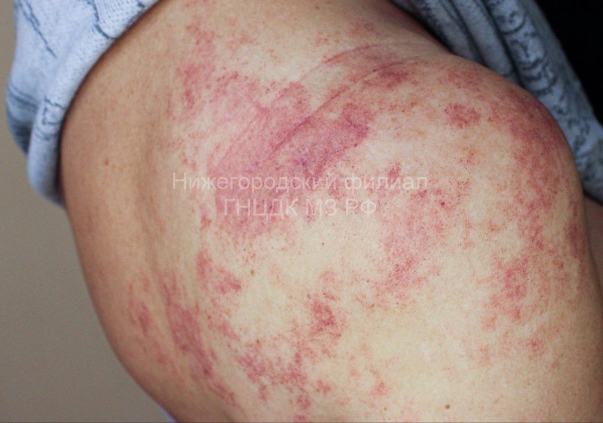 Пациентку с последствиями укуса гадюки спасли в Нижнем Новгороде