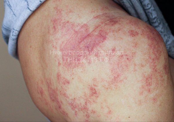 Пациентку с последствиями укуса гадюки спасли в Нижнем Новгороде