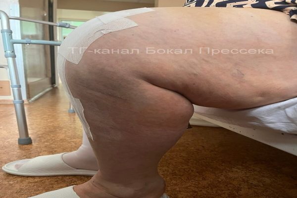 Нижегородские врачи заменили сустав пациентке с весом более 120 кг