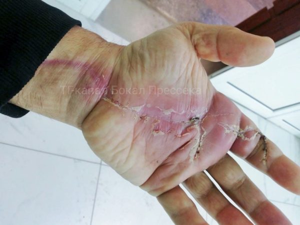 Нижегородские врачи спасли дачника, который отпилил себе руку