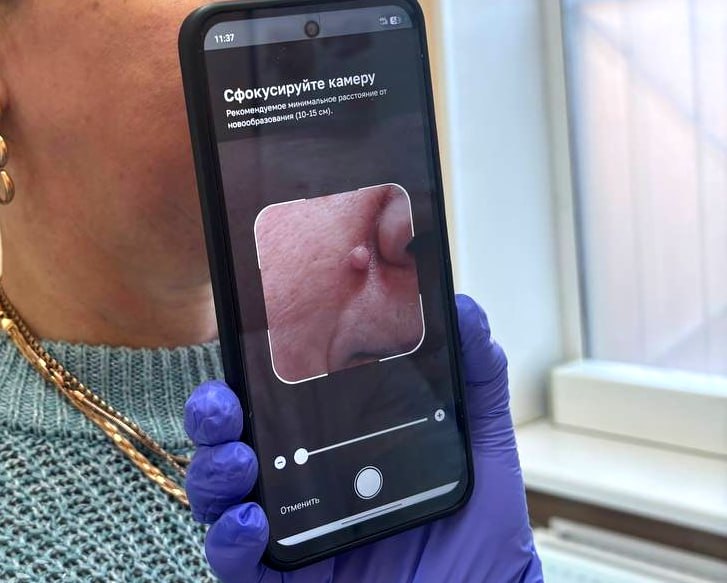 В нижегородских поликлиниках начали проверять родинки с помощью ИИ