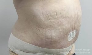 Нижегородские хирурги удалили более 7 кг кожи и жира с живота пациентки